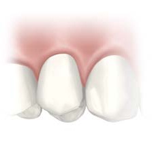 Mouth Illustration with seamless Dental Implant.