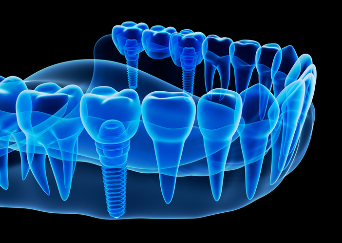 Image representing the Benefits of Dental Implants at Coulter Family Dentistry in Spokane Valley, WA