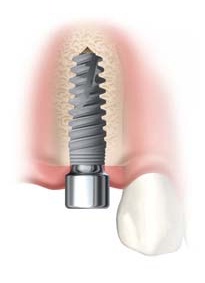 Dental Implant Placement in Bone (Illustration)