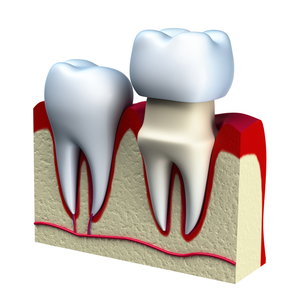 Dental Crowns in Spokane Valley, Washington with Coulter Family Dentistry