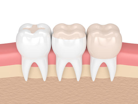 Image of a dental filling, at Coulter Family Dentistry.