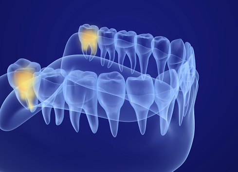 A 3d rendering of where the wisdom teeth are located at Coulter Family Dentistry in Spokane Valley, WA