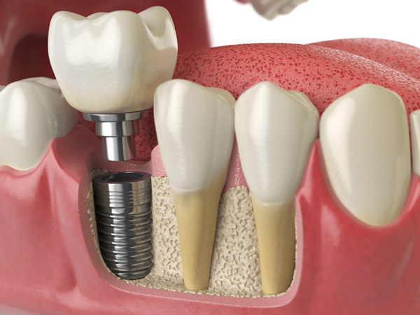 Diagram of dental implant into jaw bone at Coulter Family Dentistry in Spokane Valley, WA