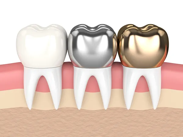 3D rendered cross-section view of three teeth with dental crowns made of different materials at Coulter Family Dentistry in Spokane Valley, WA