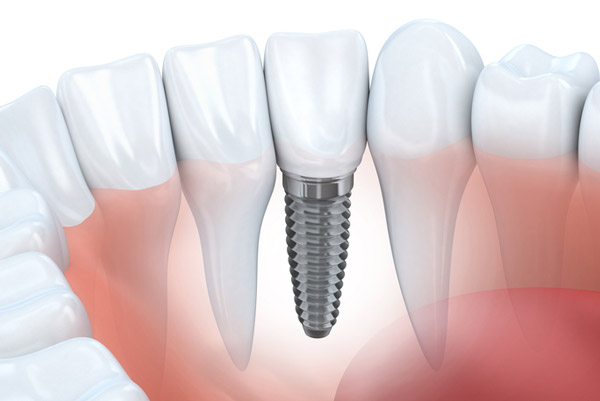 Diagram of dental implant in lower jaw from Coulter Family Dentistry in Spokane Valley, WA